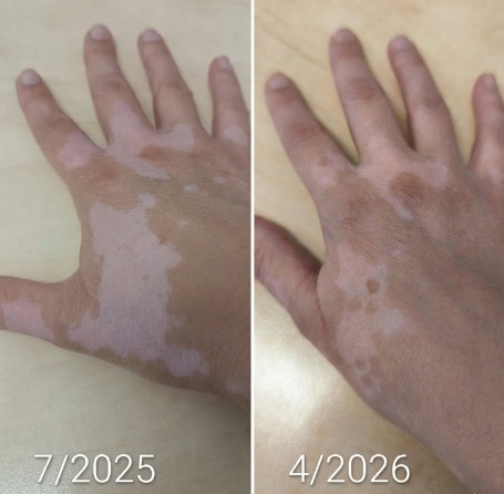 Risultati di Vitistop Gel e fototerapia sulle mani