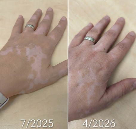 Progressi visibili della ripigmentazione sulle mani