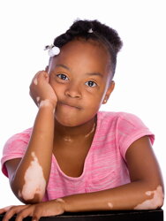 Vitiligo u deti