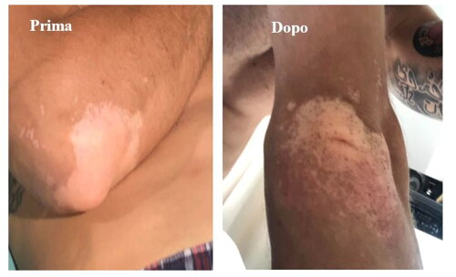 Vitiligo ripigmentazione