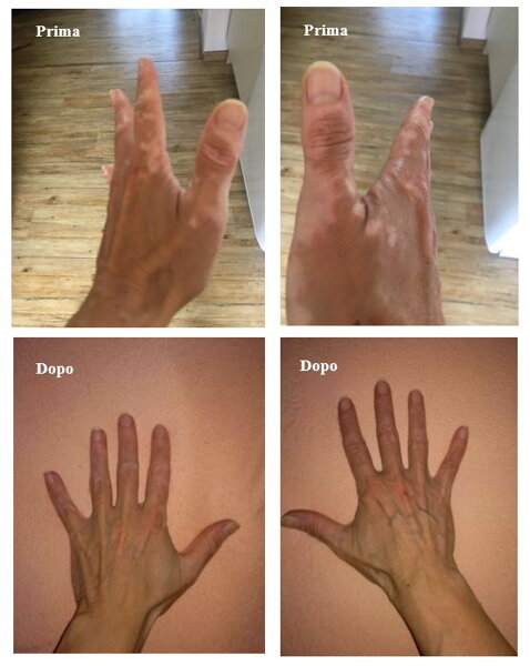 Vitiligine sulle mani prima e dopo