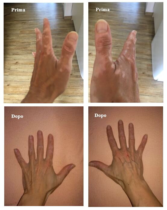 Vitiligine sulle mani prima e dopo – Pietra K., cliente di VitiligoShop