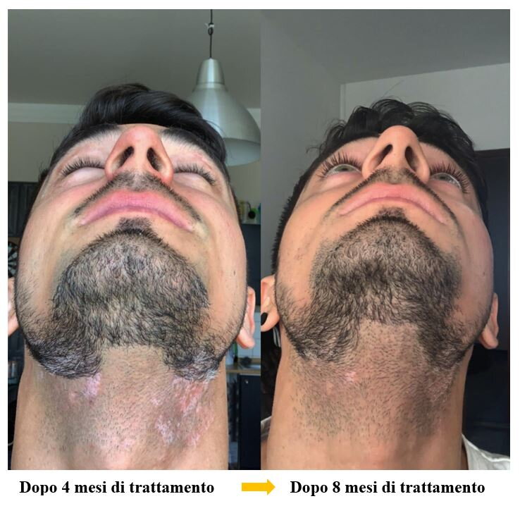 Vitiligine sul collo prima e dopo – Pietro, cliente di VitiligoShop