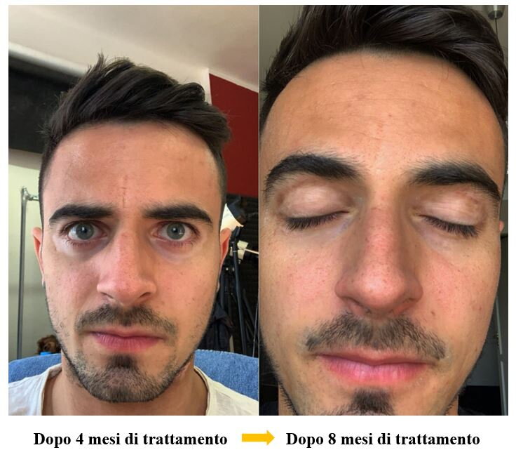 Vitiligine sul viso dopo 4 e 8 mesi – Pietro, cliente di VitiligoShop